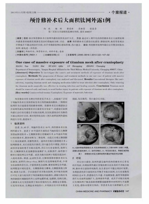 颅骨修补术后大面积钛网外露1例