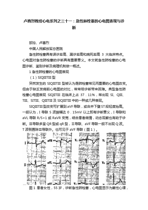 卢喜烈教授心电系列之三十一：急性肺栓塞的心电图表现与诊断