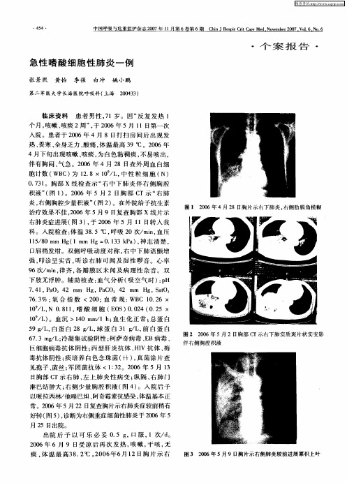 急性嗜酸细胞性肺炎一例