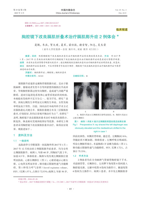 胸腔镜下改良膈肌折叠术治疗膈肌膨升症2例体会