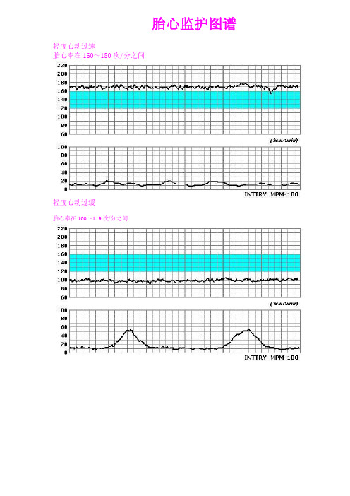 胎心监护图谱