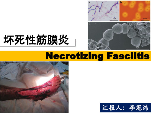 坏死性筋膜炎-Necrotizing-Fasciitis