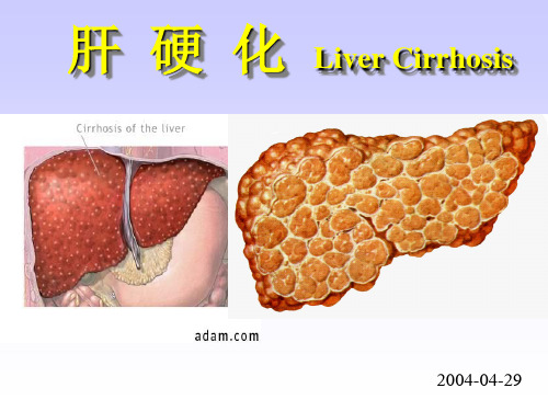 肝硬化肝癌PPT课件