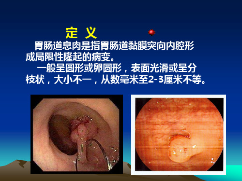 胃肠道息肉内镜下电凝切除术