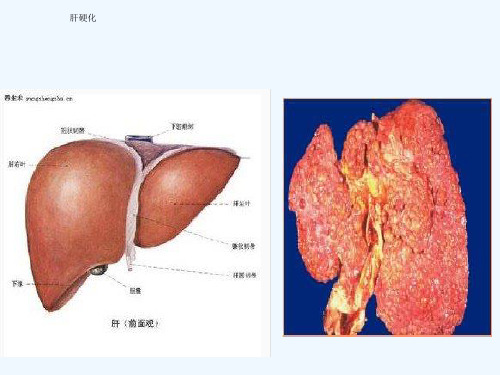 内科学肝硬化