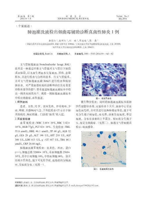 肺泡灌洗液检出烟曲霉辅助诊断真菌性肺炎1例