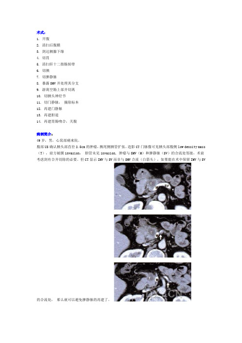 胰十二指肠切除术