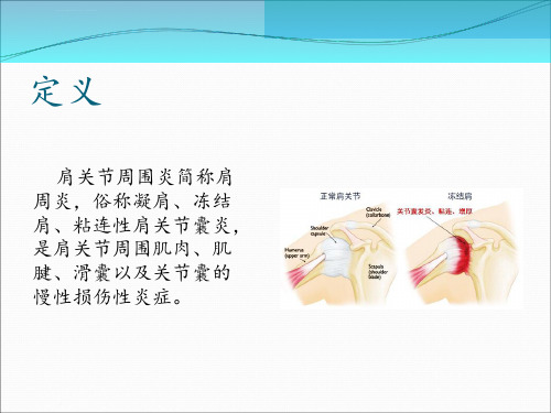 肩周炎的康复护理ppt课件