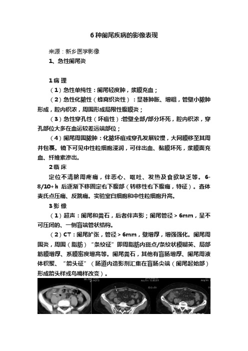 6种阑尾疾病的影像表现