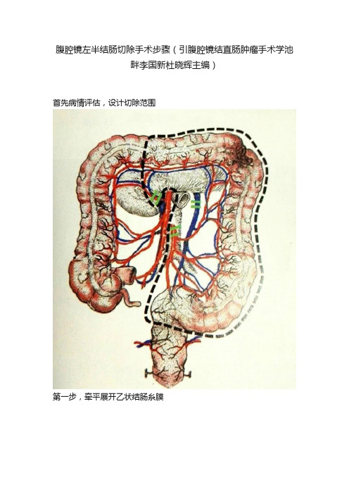 腹腔镜左半结肠切除手术步骤（引腹腔镜结直肠肿瘤手术学池畔李国新杜晓辉主编）