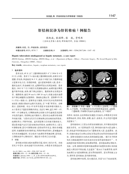 肝结核误诊为肝转移癌1例报告 张凯庭