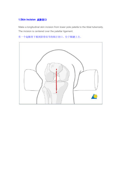 胫骨顺行髓内钉手术入路