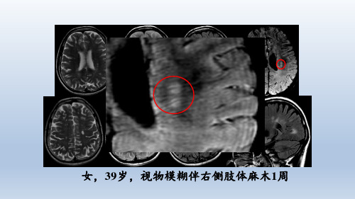 大脑半球髓静脉解剖及相关疾病