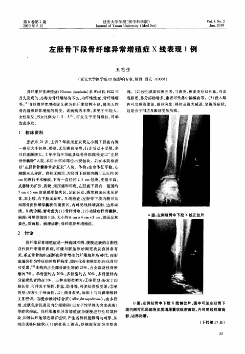 左胫骨下段骨纤维异常增殖症X线表现1例