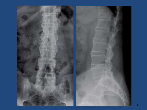 强直性脊柱炎(Ankylosing--Spondylitis-AS)-PPT