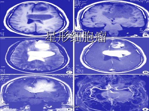 《星形细胞瘤》PPT课件