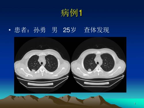 肺错构瘤影像表现ppt课件