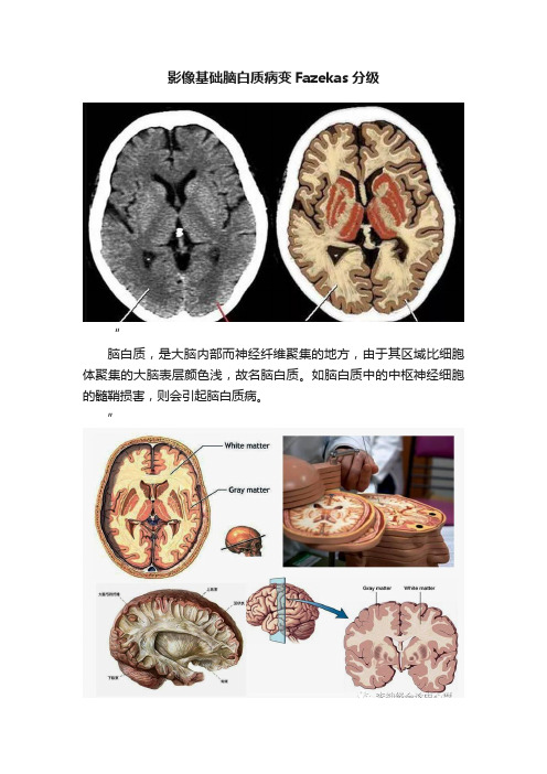 影像基础脑白质病变Fazekas分级