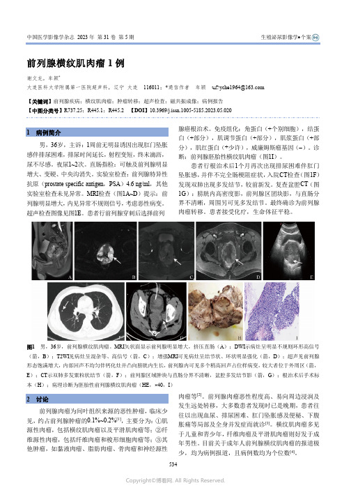 前列腺横纹肌肉瘤1例