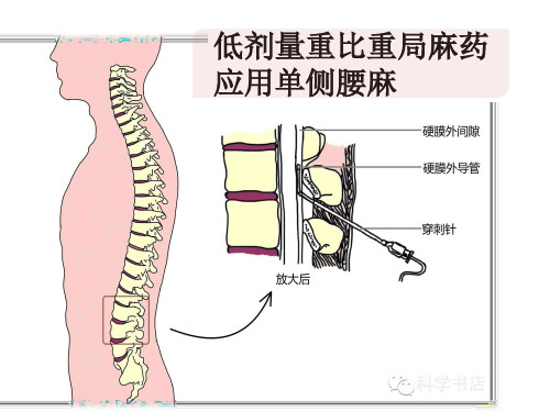 重比重单侧腰麻xjq