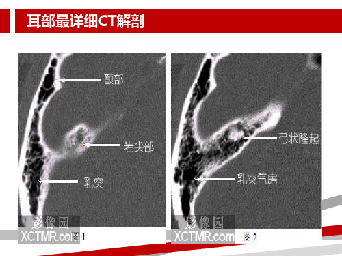 耳部最详细CT解剖