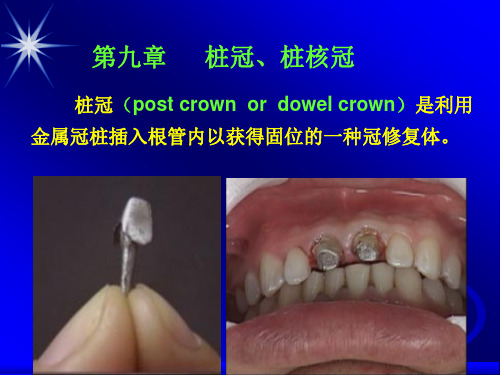 第九章 桩冠、桩核冠