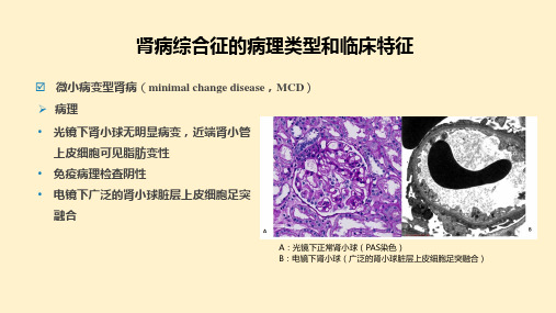 肾病综合征的病理类型和临床特征