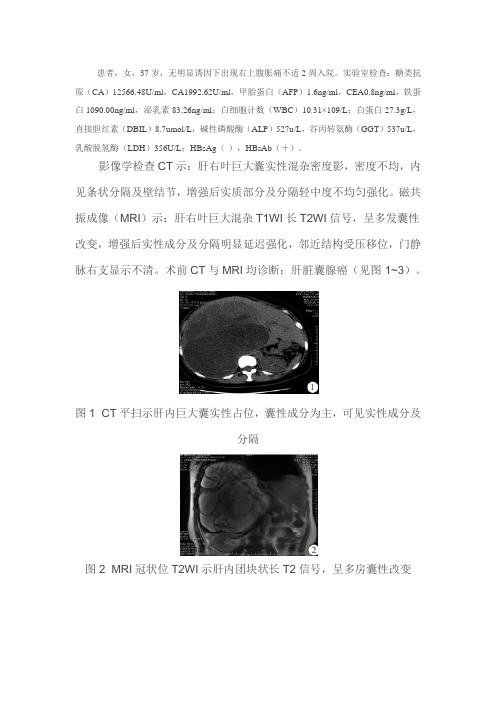 成人肝脏巨大未分化胚胎性肉瘤