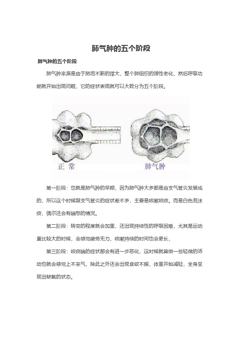 肺气肿的症状表现分为五个阶段及治疗方法