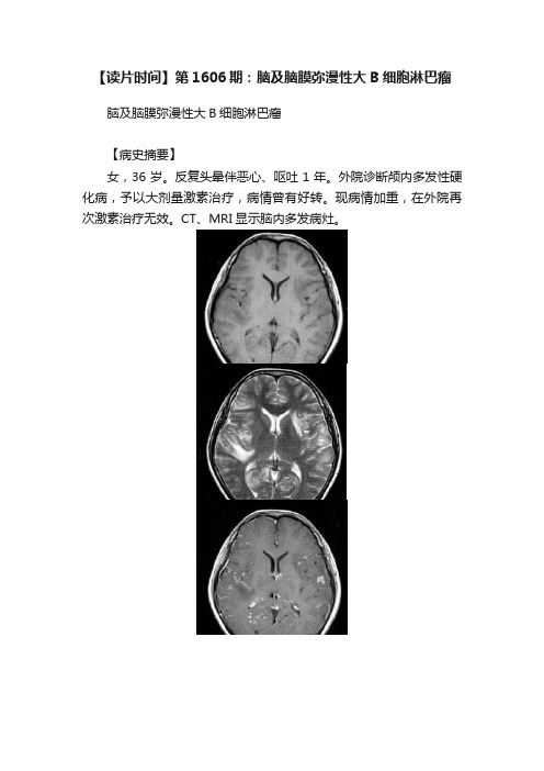 【读片时间】第1606期：脑及脑膜弥漫性大B细胞淋巴瘤