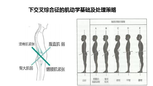 姿态评估之下交叉综合症及运动指导