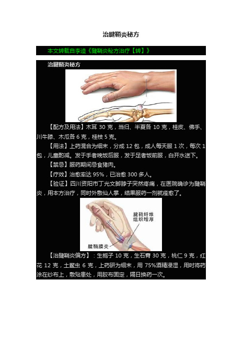 治腱鞘炎秘方