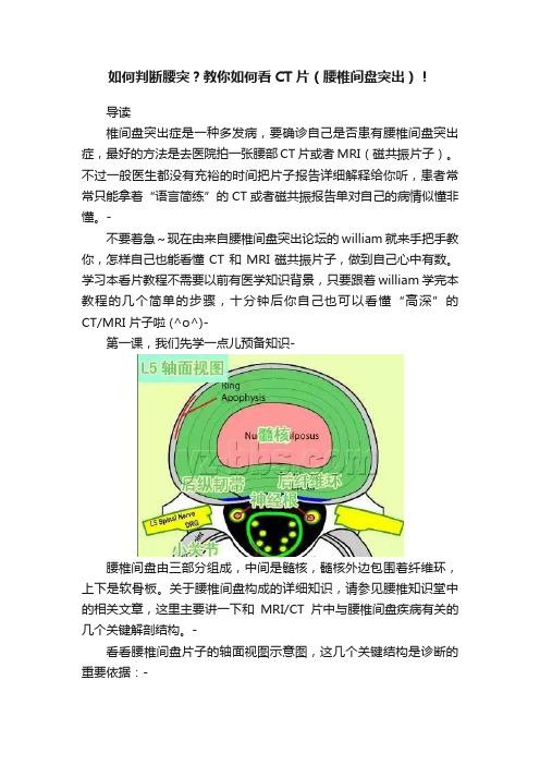 如何判断腰突？教你如何看CT片（腰椎间盘突出）！