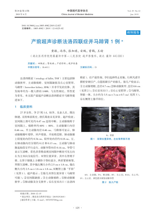 产前超声诊断法洛四联症并马蹄肾1例