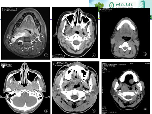 咽旁间隙病变的影像诊断及鉴别病例
