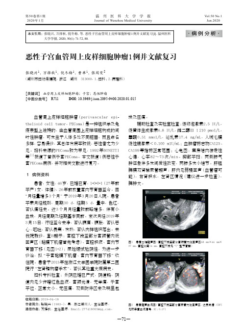 恶性子宫血管周上皮样细胞肿瘤1例并文献复习