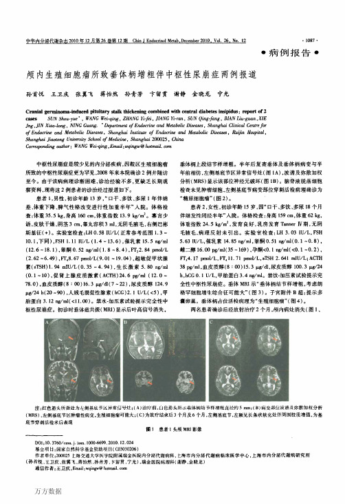 颅内生殖细胞瘤所致垂体柄增粗伴中枢性尿崩症两例报道
