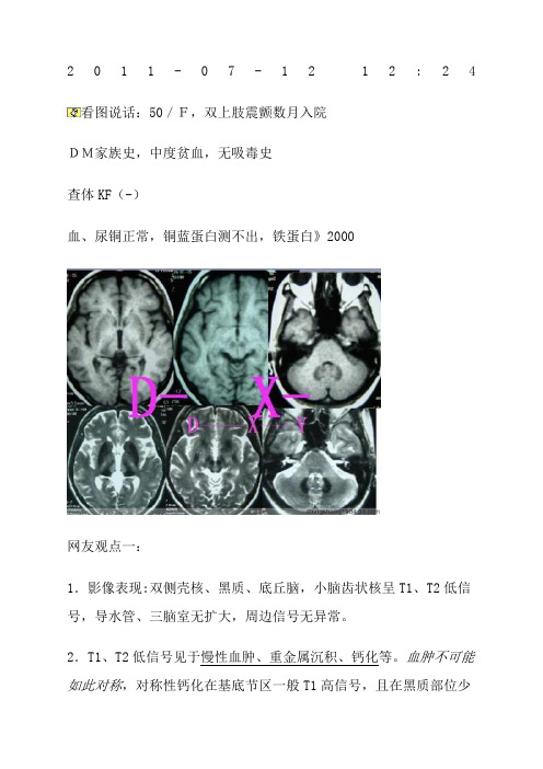 颅内T低信号总结包括正常及病变