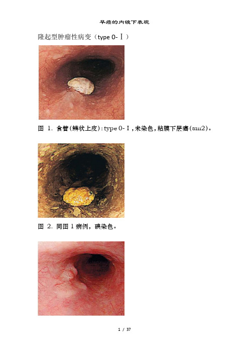 早癌的内镜下表现