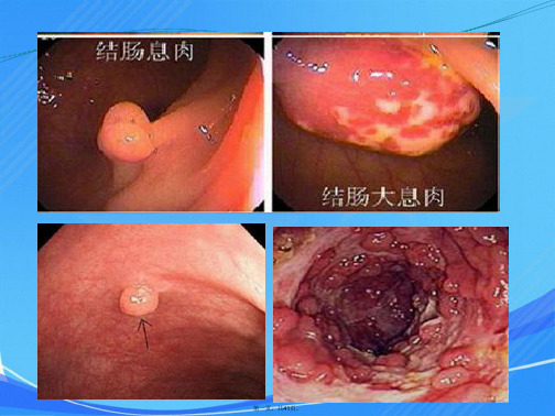 教学查房结肠息肉