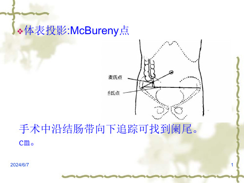 阑尾炎概论PPT课件