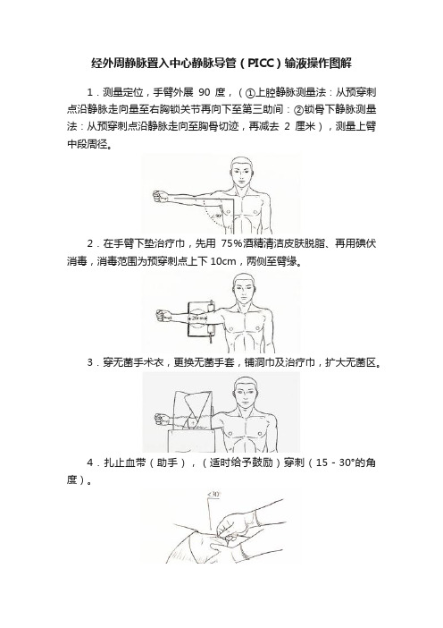 经外周静脉置入中心静脉导管（PICC）输液操作图解