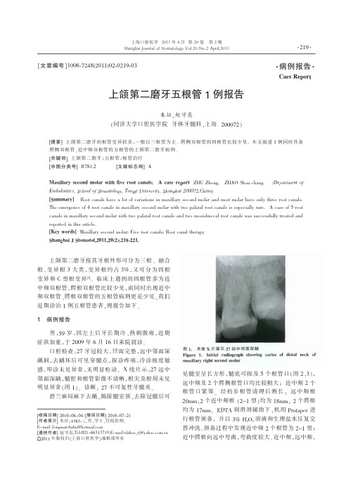 上颌第二磨牙五根管1例报告