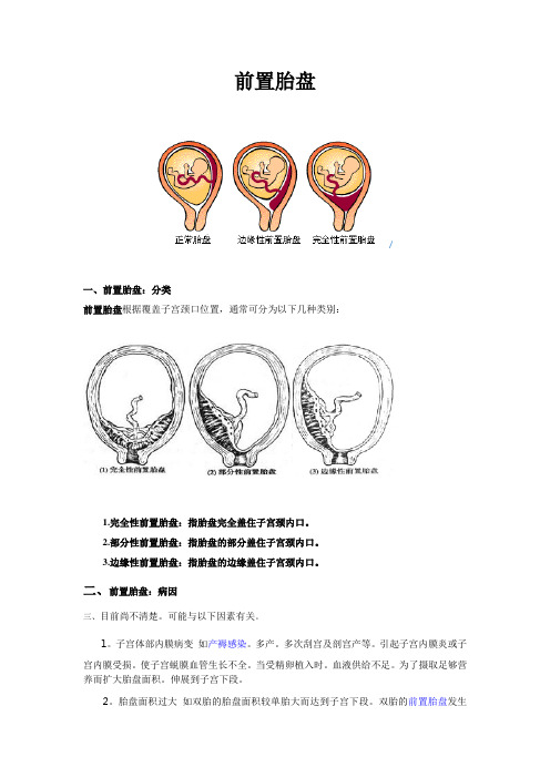 前置胎盘