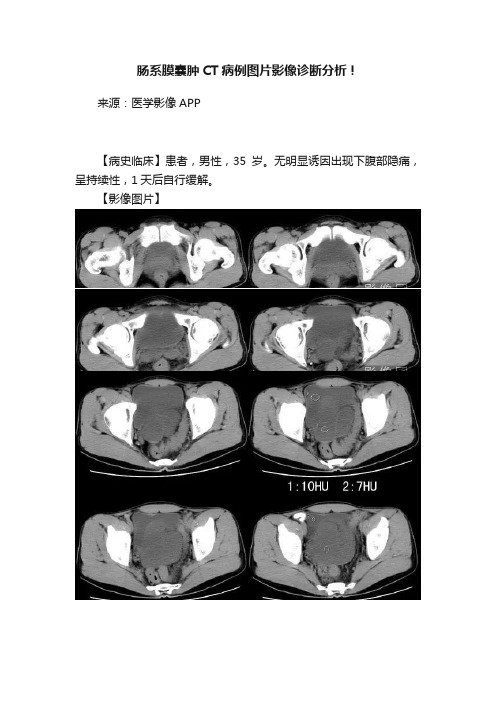 肠系膜囊肿CT病例图片影像诊断分析！