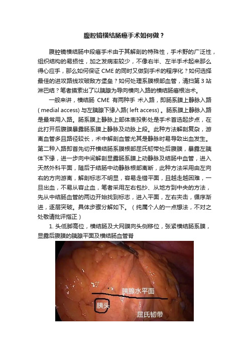 腹腔镜横结肠癌手术如何做？