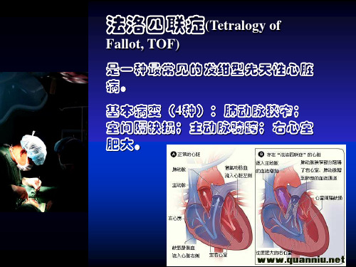 法洛四联症(精品)PPT课件