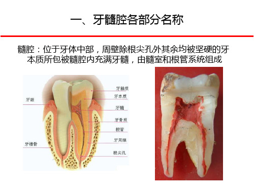 下颌磨牙髓腔解剖及开髓