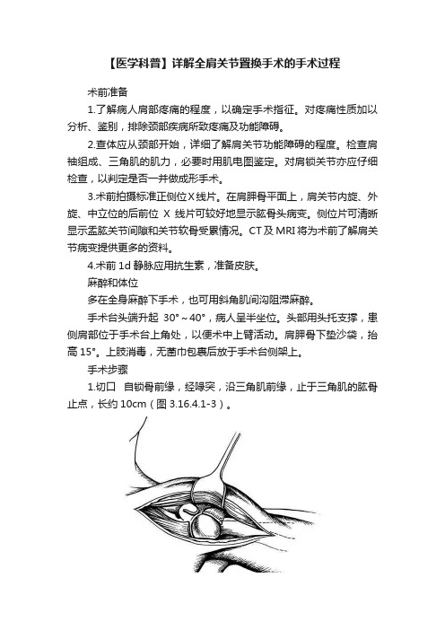 【医学科普】详解全肩关节置换手术的手术过程