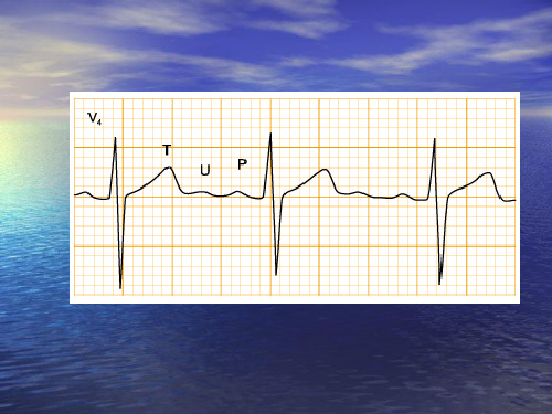 中国区国际心电图培训课程之典型病例